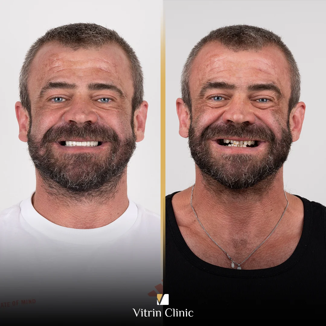 Oliver antes e depois
